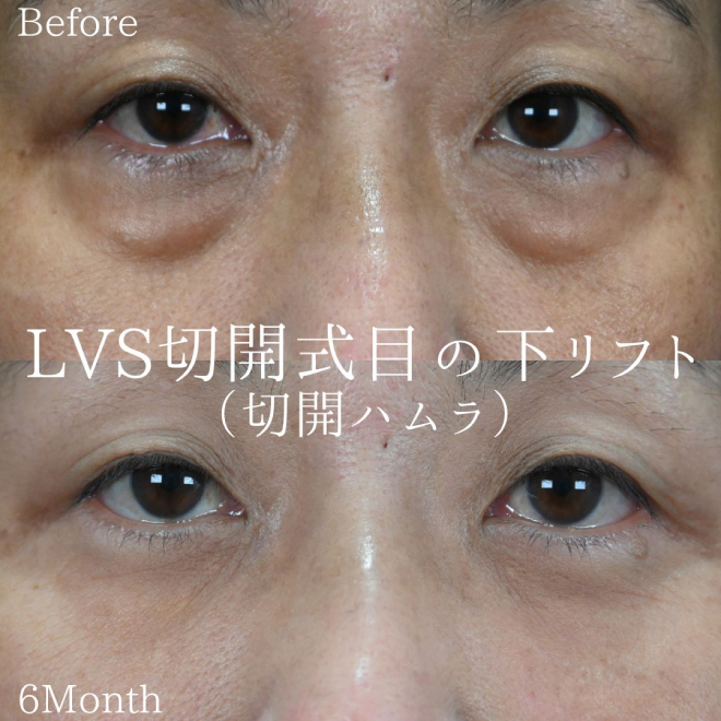 LVS切開式目の下リフト (切開ハムラ)before/after