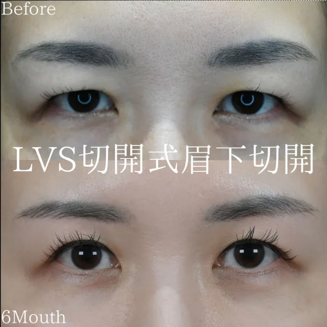 LVS切開式眉下切開リフトbefore/6month