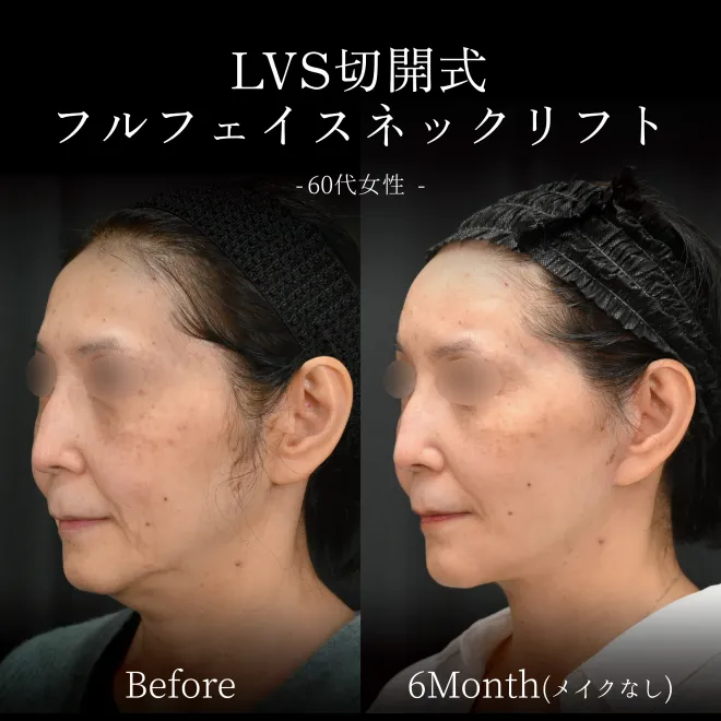 LVS切開式フルフェイスネックリフトbefore/6month