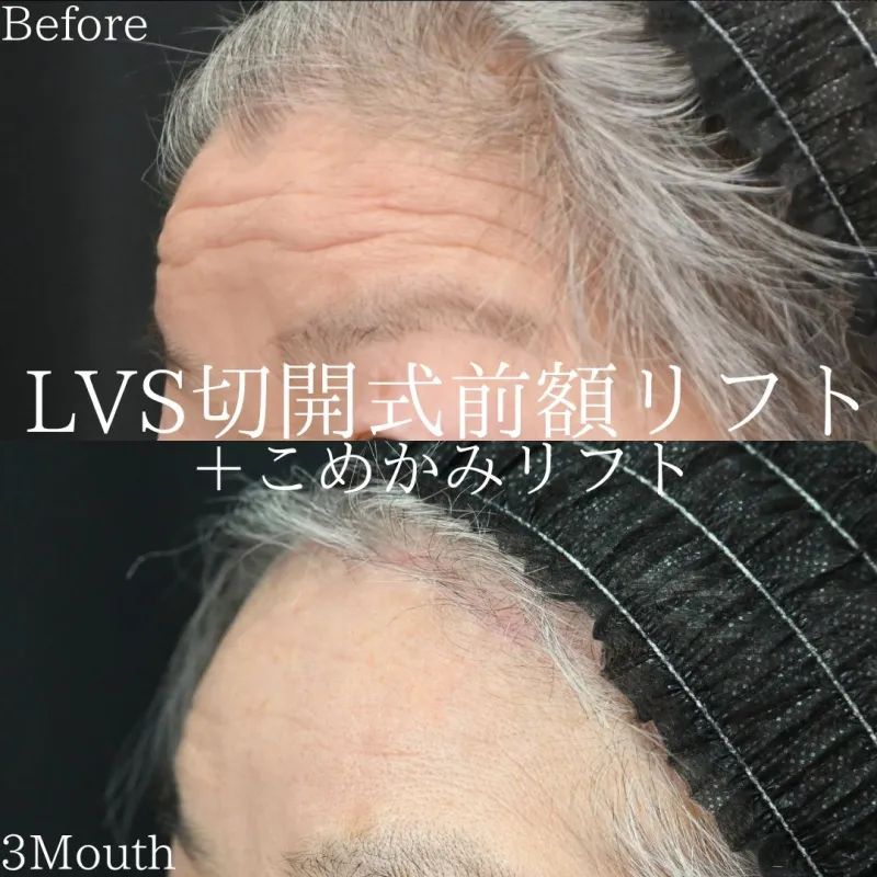 LVS切開式前額リフトbefore/after