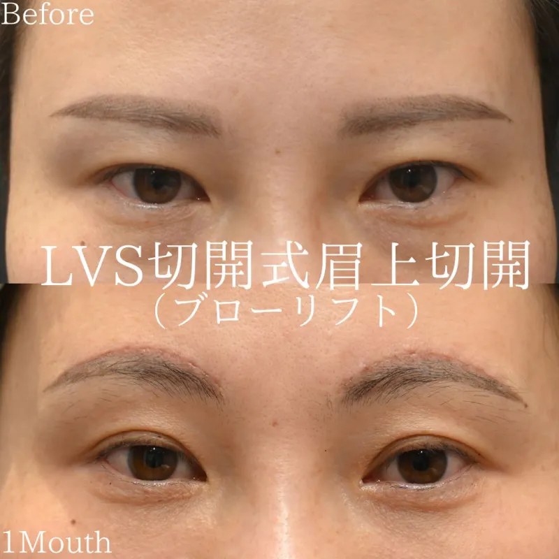 LVS切開式眉上切開リフトbefore/after