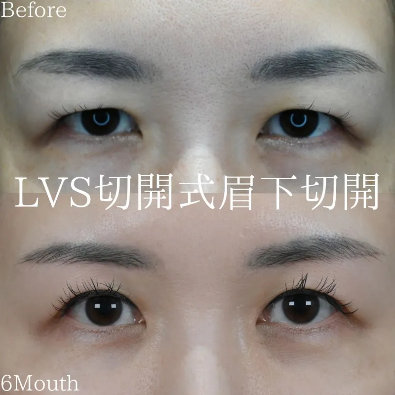 LVS切開式眉下切開リフトbefore/after