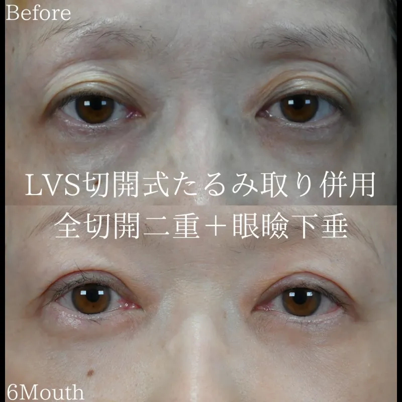 LVS切開式たるみ取り＋全切開二重（眼瞼下垂手術）before/after