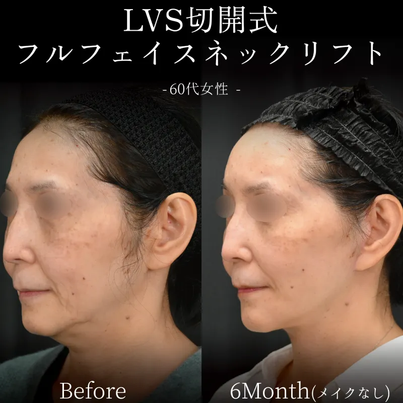 LVS切開式フルフェイスネックリフトbefore/after