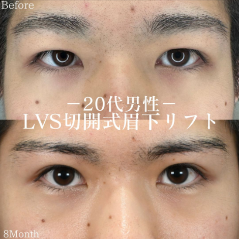 20代男性の眉下切開リフト施術前後の写真