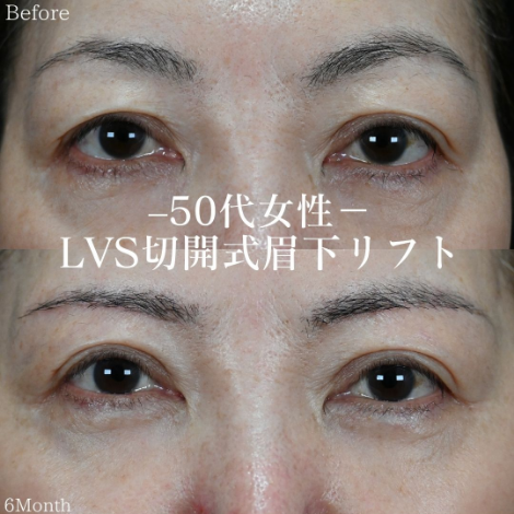 50代女性の眉下切開リフト施術前後の写真2