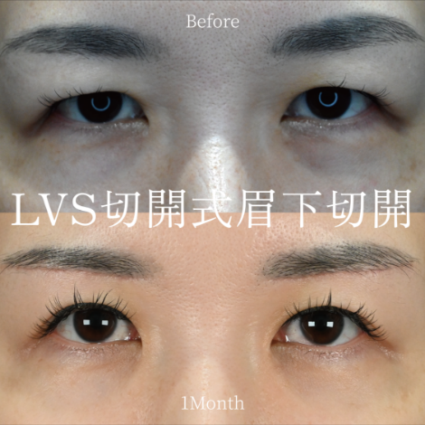 40代女性の眉下切開リフト施術前後の写真1