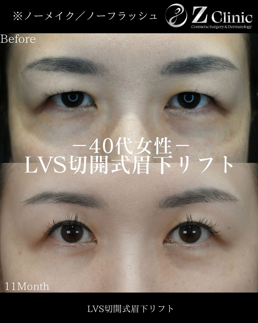東京・銀座で眉下切開・眉下リフトの美容クリニックzclinicの情報