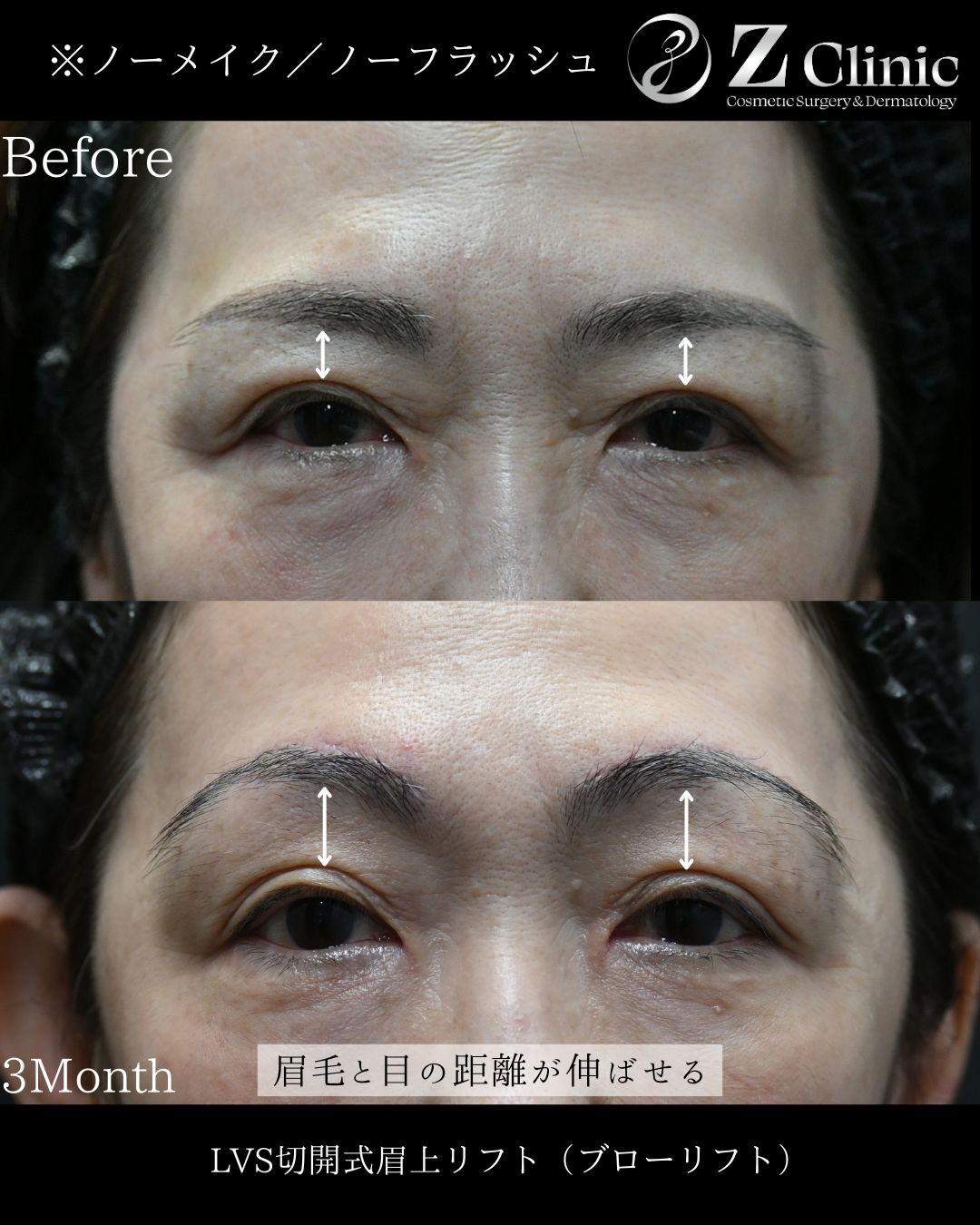 東京・銀座で眉下切開・眉下リフトの美容クリニックzclinicの情報