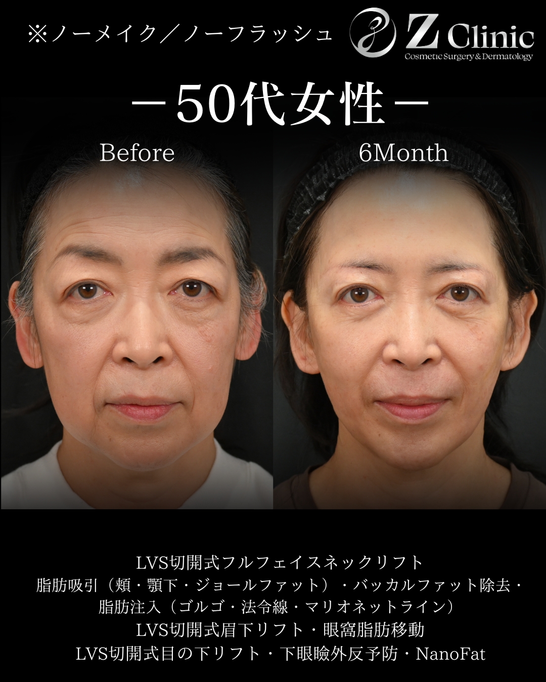 東京・銀座で眉下切開・眉下リフトの美容クリニックzclinicの情報