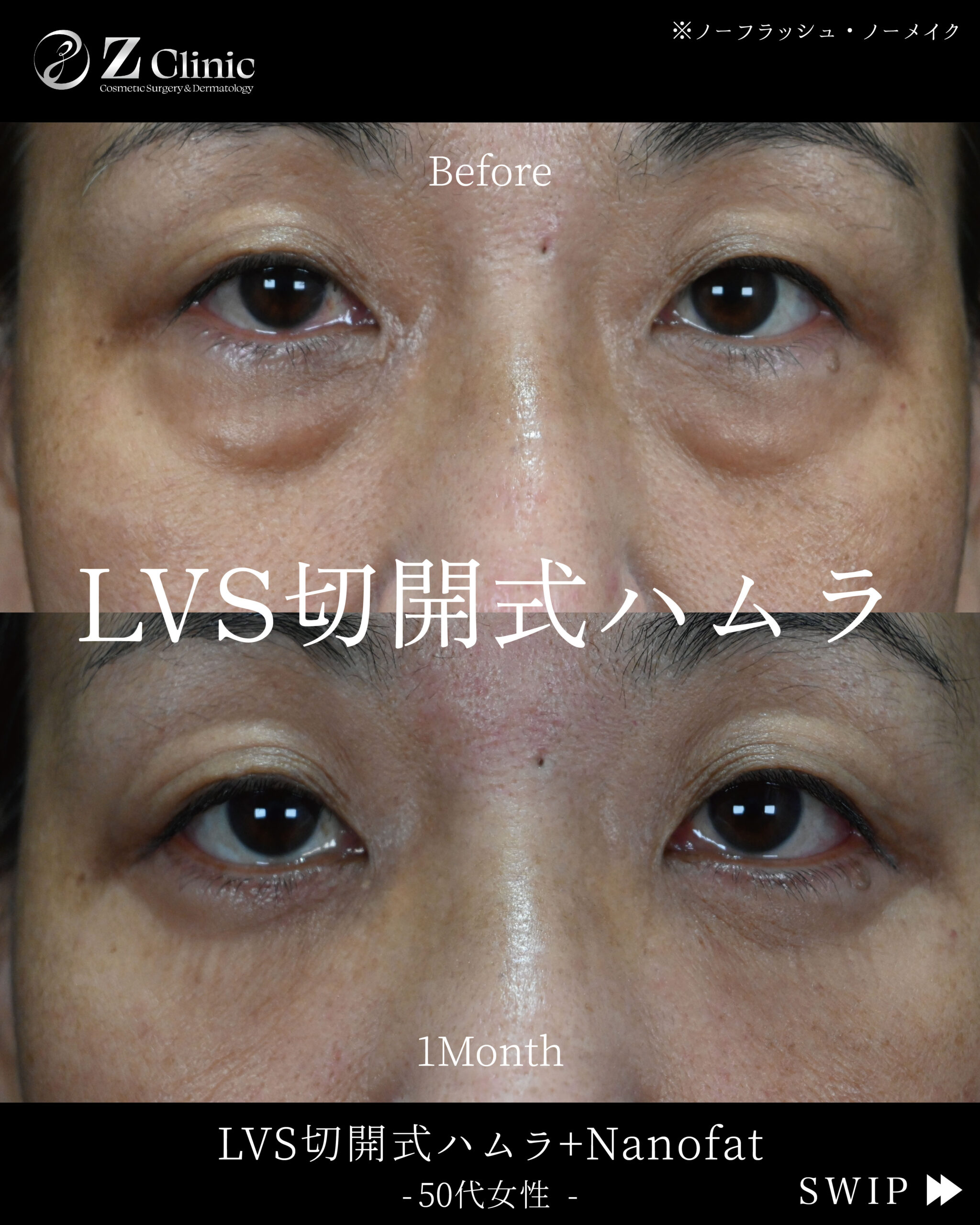 東京・銀座で眉下切開・眉下リフトの美容クリニックzclinicの情報