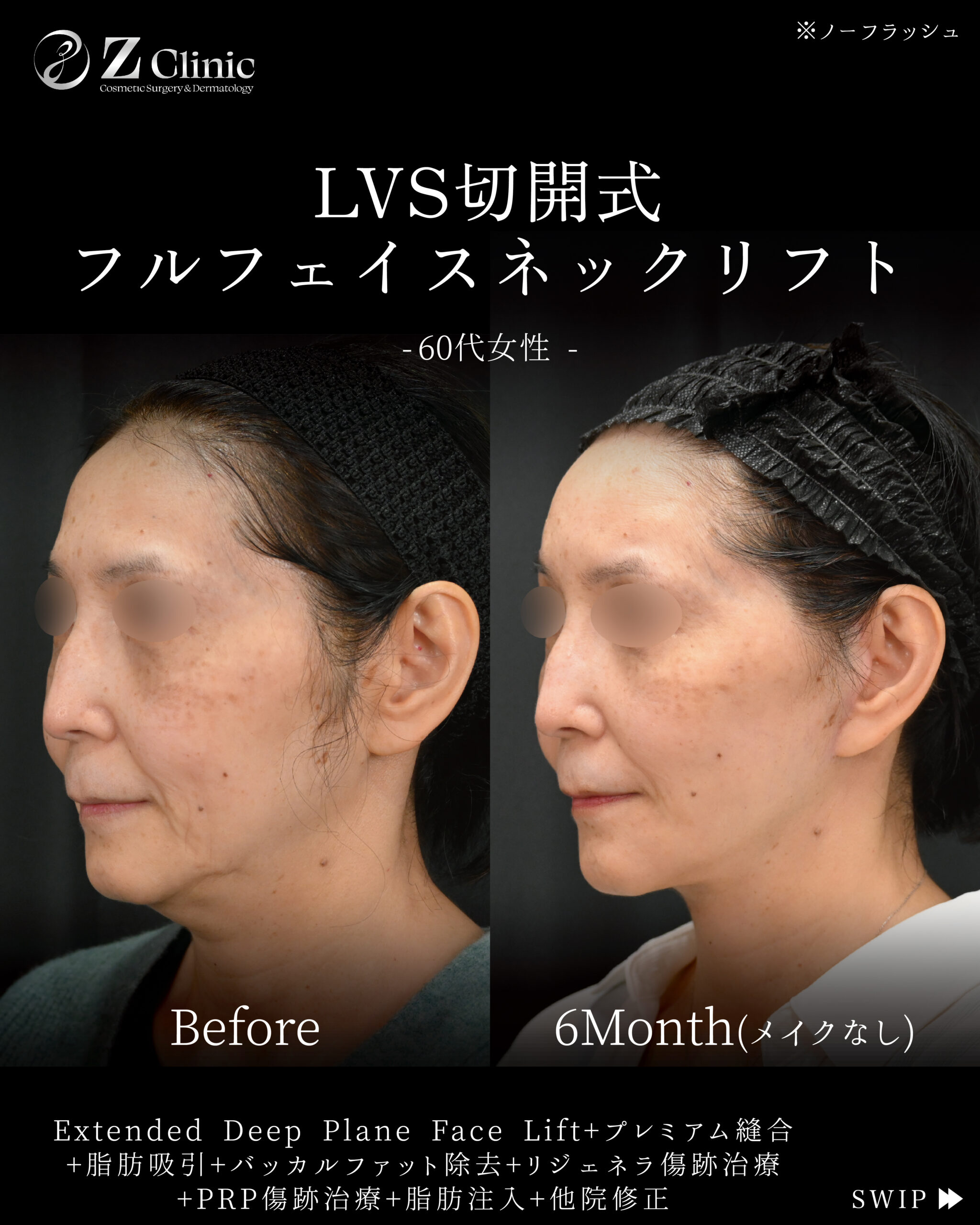 東京・銀座で眉下切開・眉下リフトの美容クリニックzclinicの情報