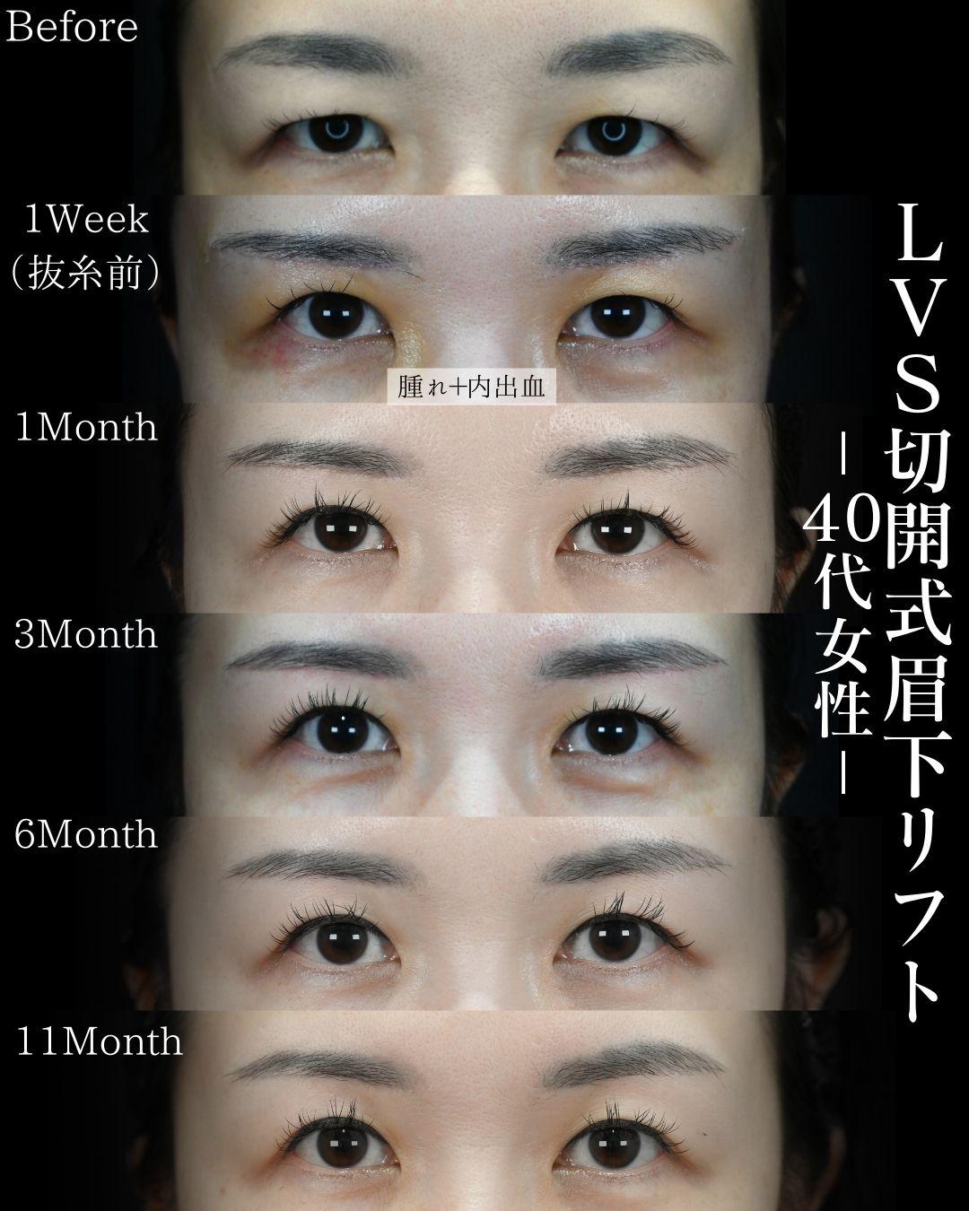 「LVS切開式眉下リフト」の症例写真