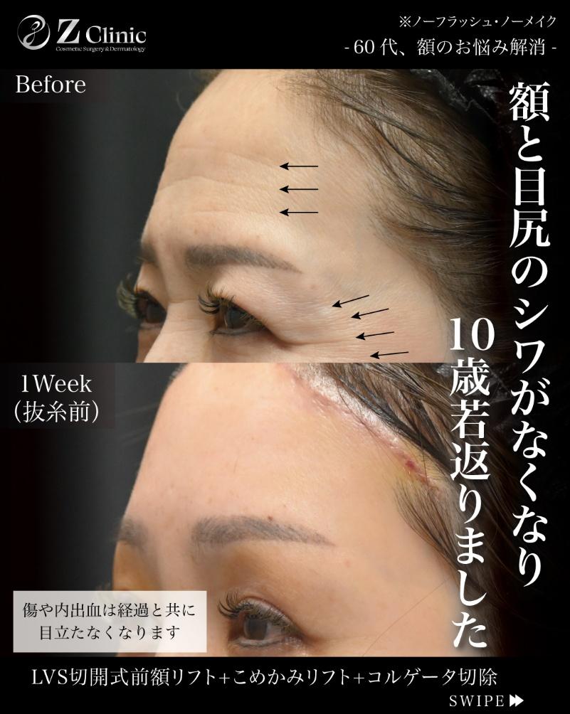 60代女性の「LVS切開式前額リフト」の症例写真