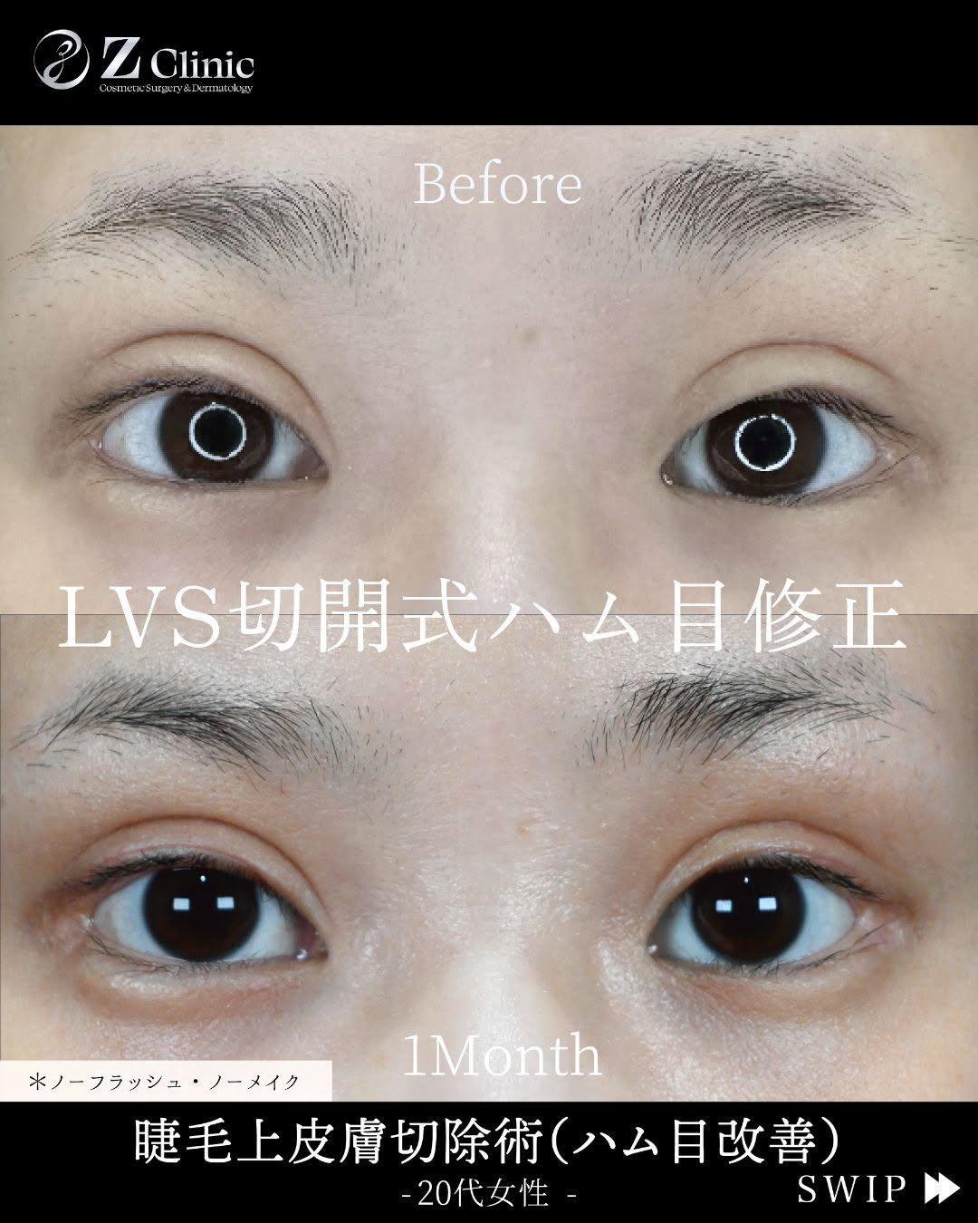 LVS切開式によるハム目修正をおこなった20代女性の症例写真