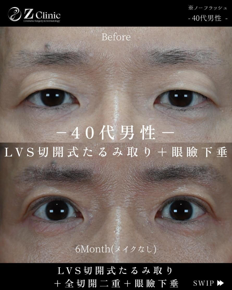 Z Clinicの全切開二重術の症例写真