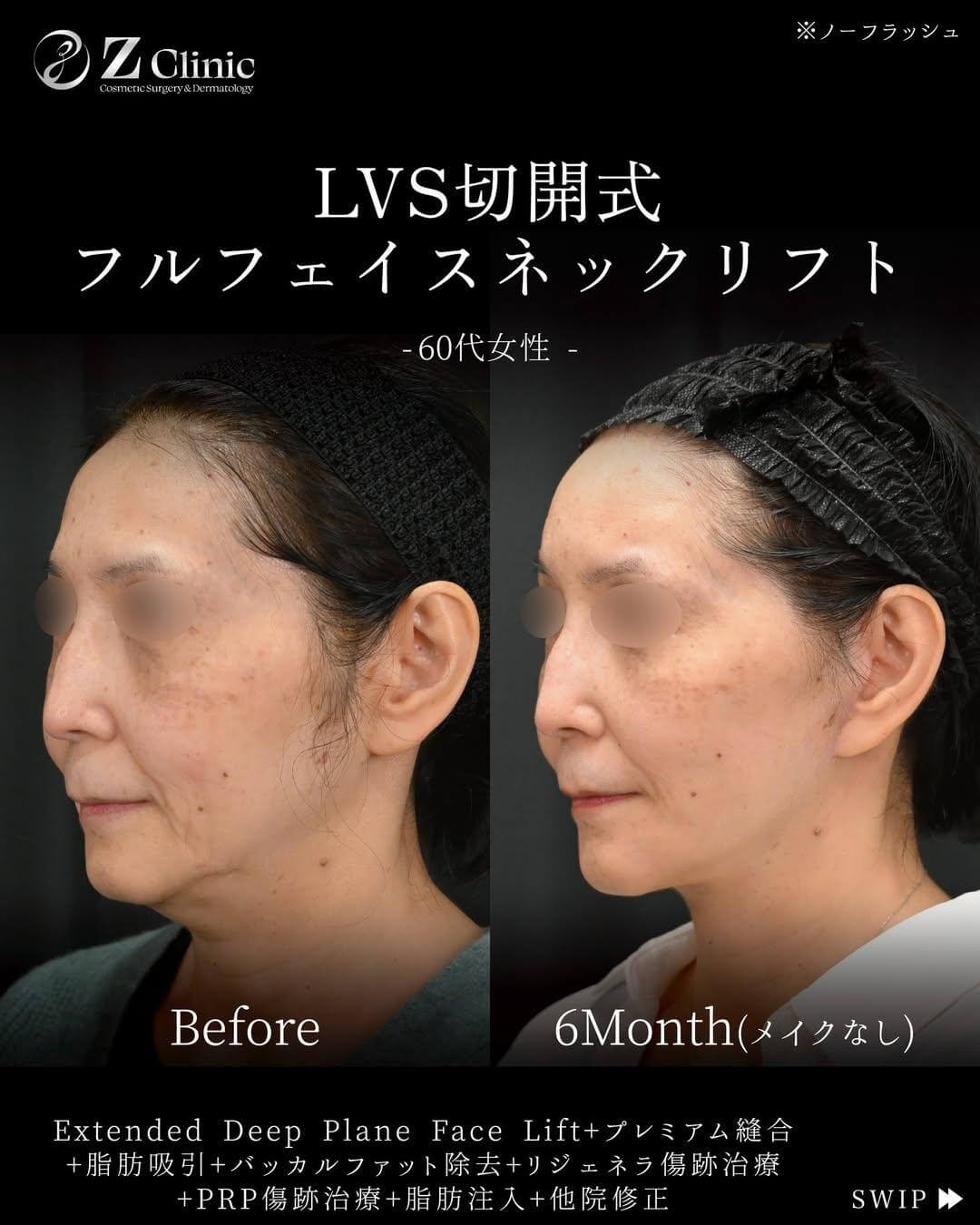 「LVS切開式フルフェイスリフト」の症例写真