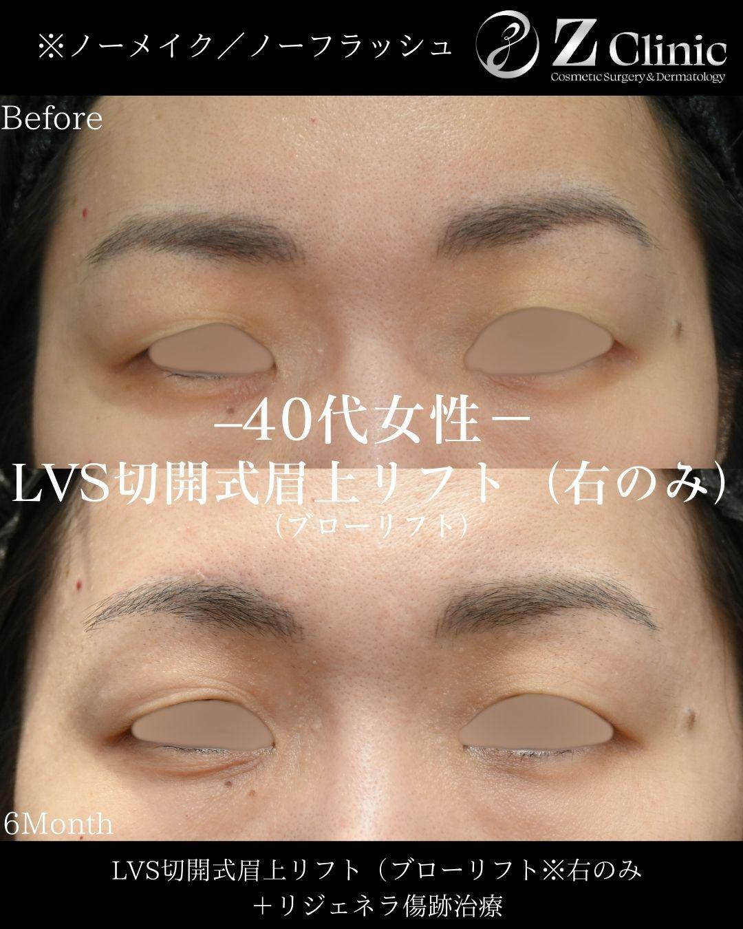 「LVS切開式眉上リフト(ブローリフト)」の施術をおこなった40代女性の症例写真