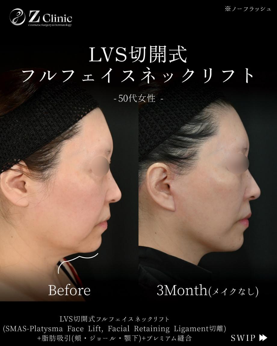 50代女性の「LVS切開式フェイスネックリフト」の症例写真