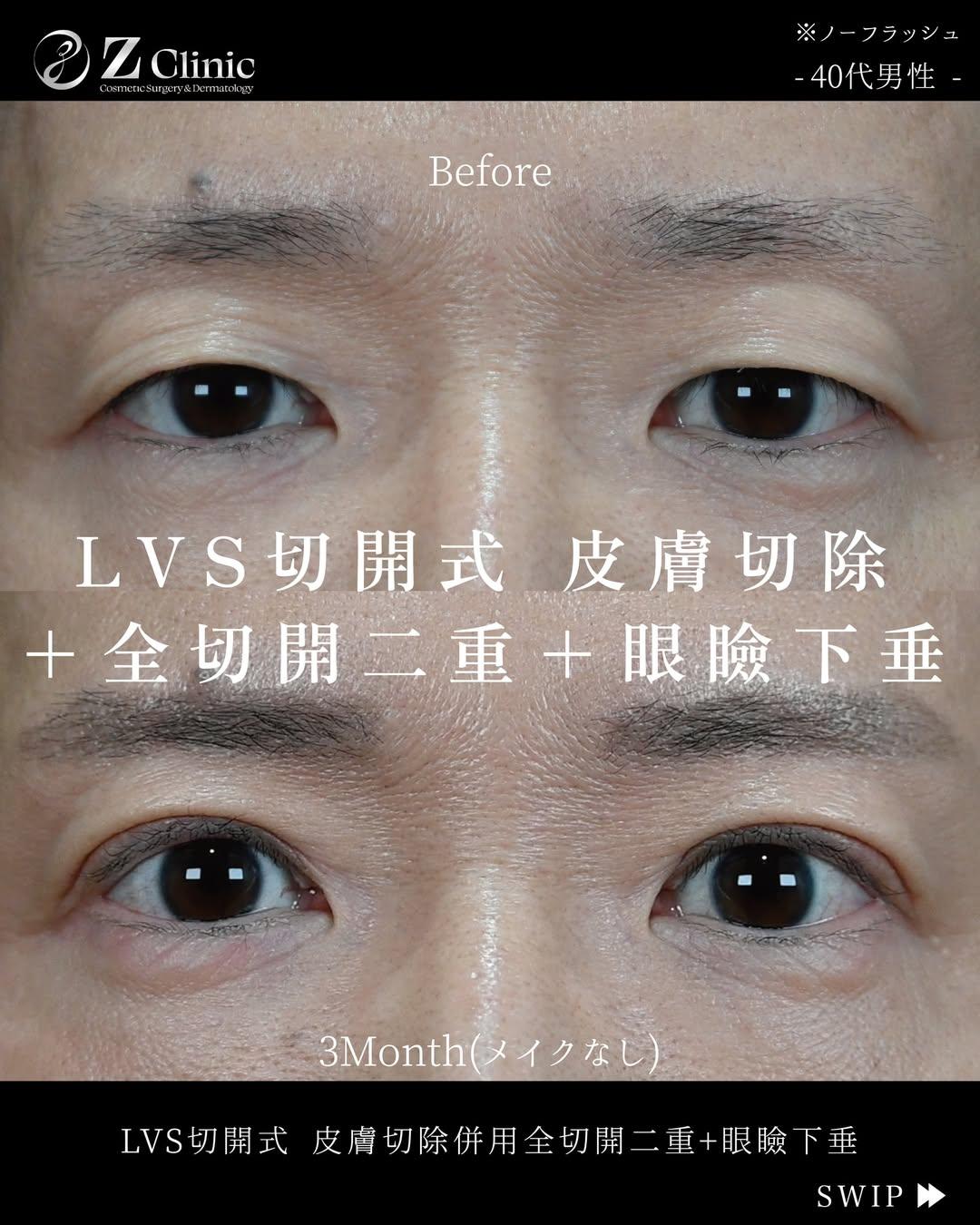 「LVS切開式・皮膚切除併用全切開二重術+眼瞼下垂手術」を受けられた40代男性の症例写真