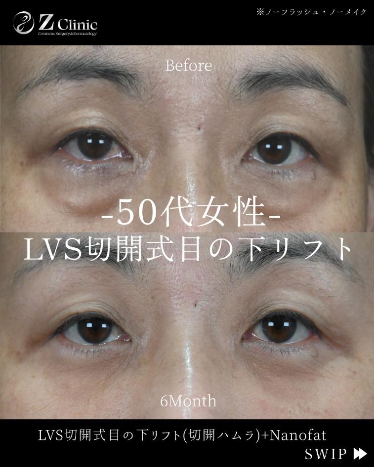 「LVS切開式目の下リフト」の施術を受けられた50代女性の症例写真