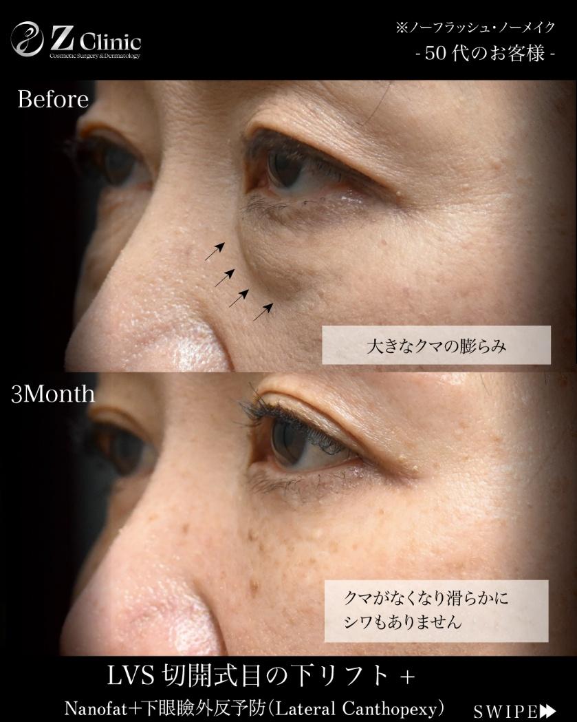 「LVS切開式目の下リフト」の施術を受けられた50代のお客様の症例