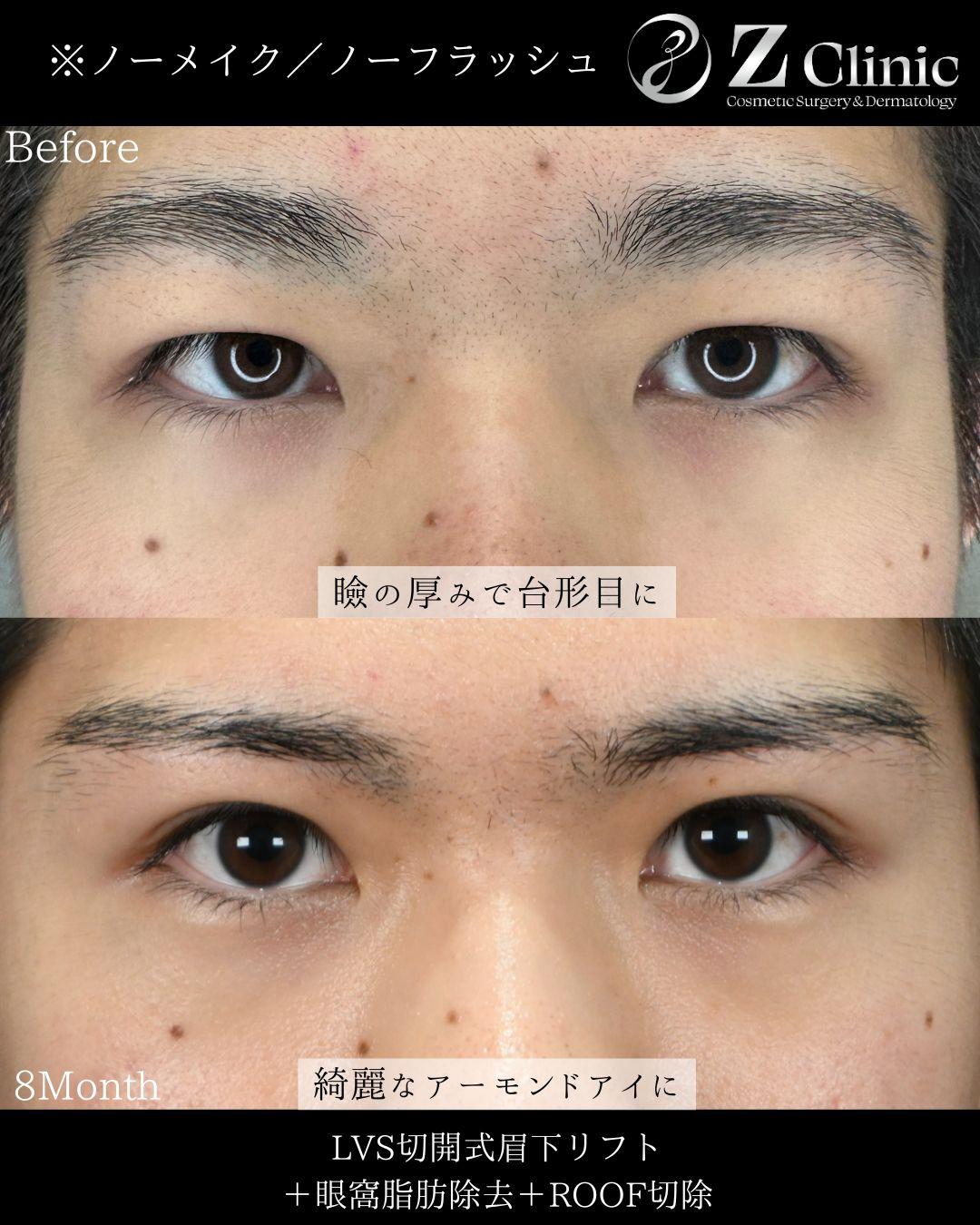 眼窩脂肪切除・ROOF切除の施術を受けられた20代男性の症例写真