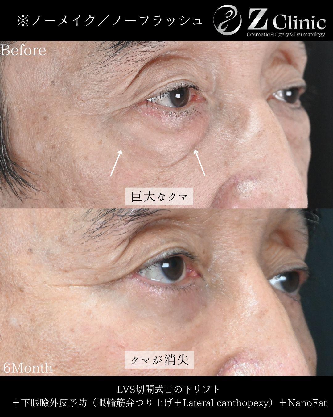 LVS切開式目の下リフトの施術を受けられた60代男性の症例写真