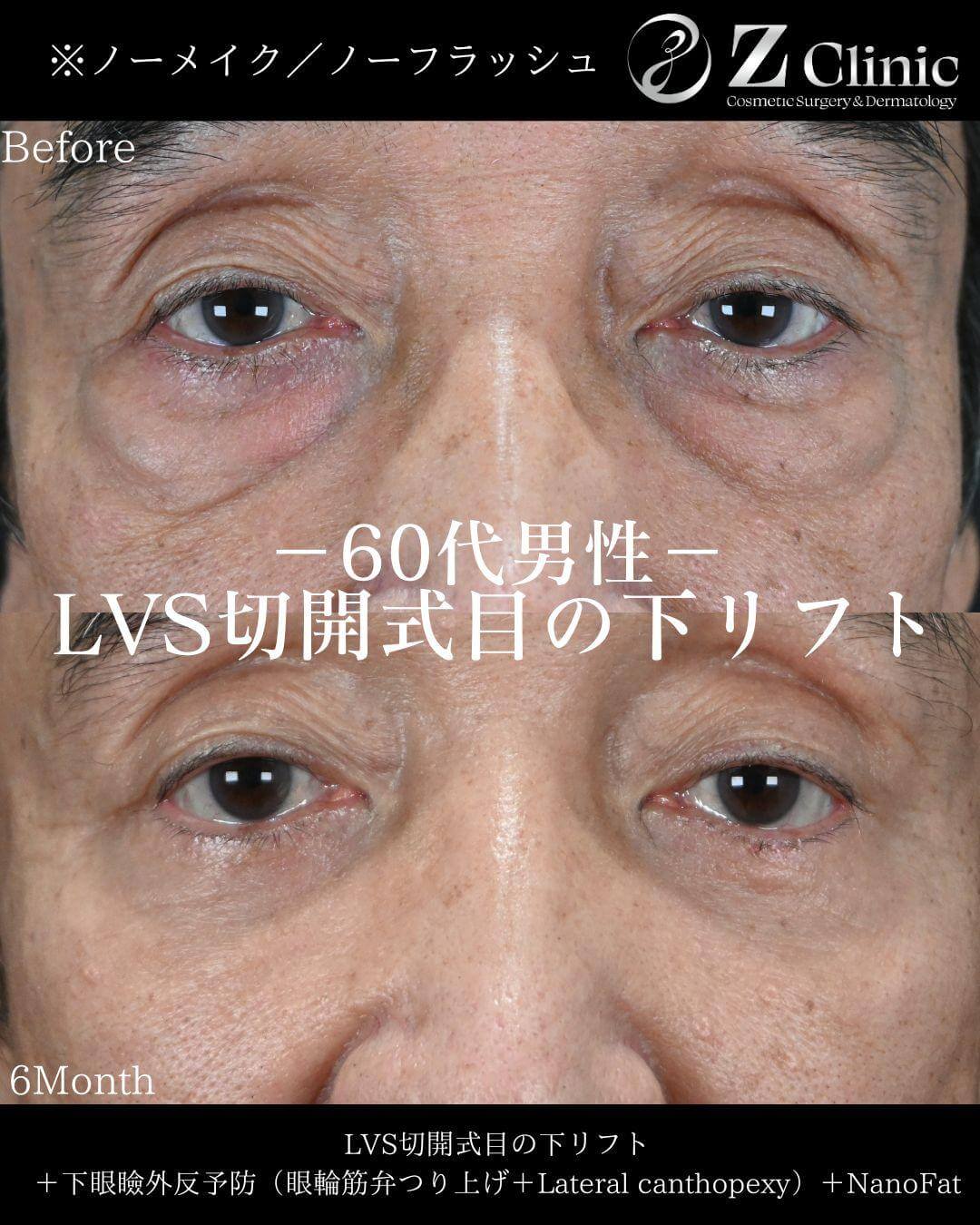 表ハムラ法(切開ハムラ法)