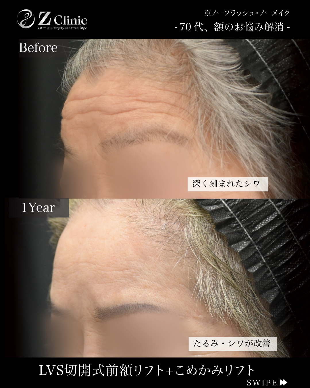 東京・銀座で眉下切開・眉下リフトの美容クリニックzclinicの画像2