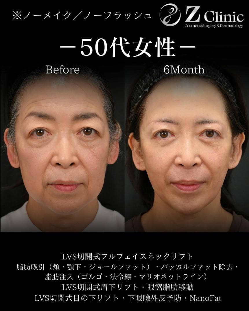 LVS切開式フルフェイスネックリフトの施術を受けた50代女性の症例写真