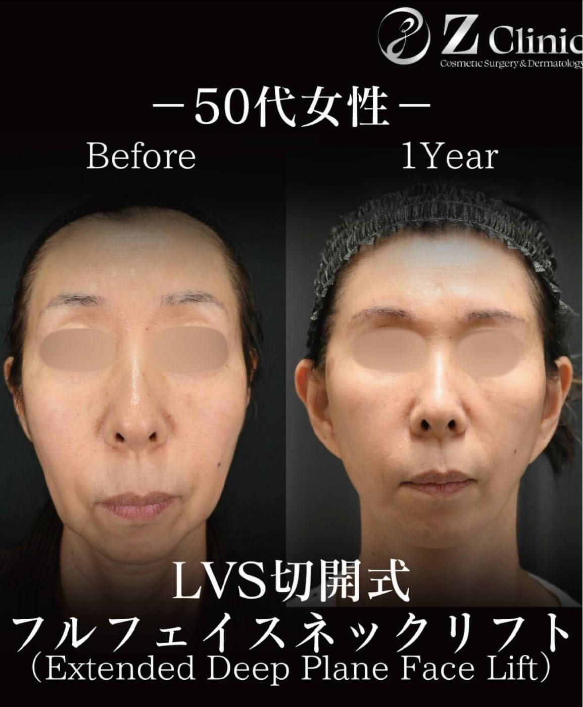 LVS切開式フルフェイスネックリフトを受けた50代女性の症例写真