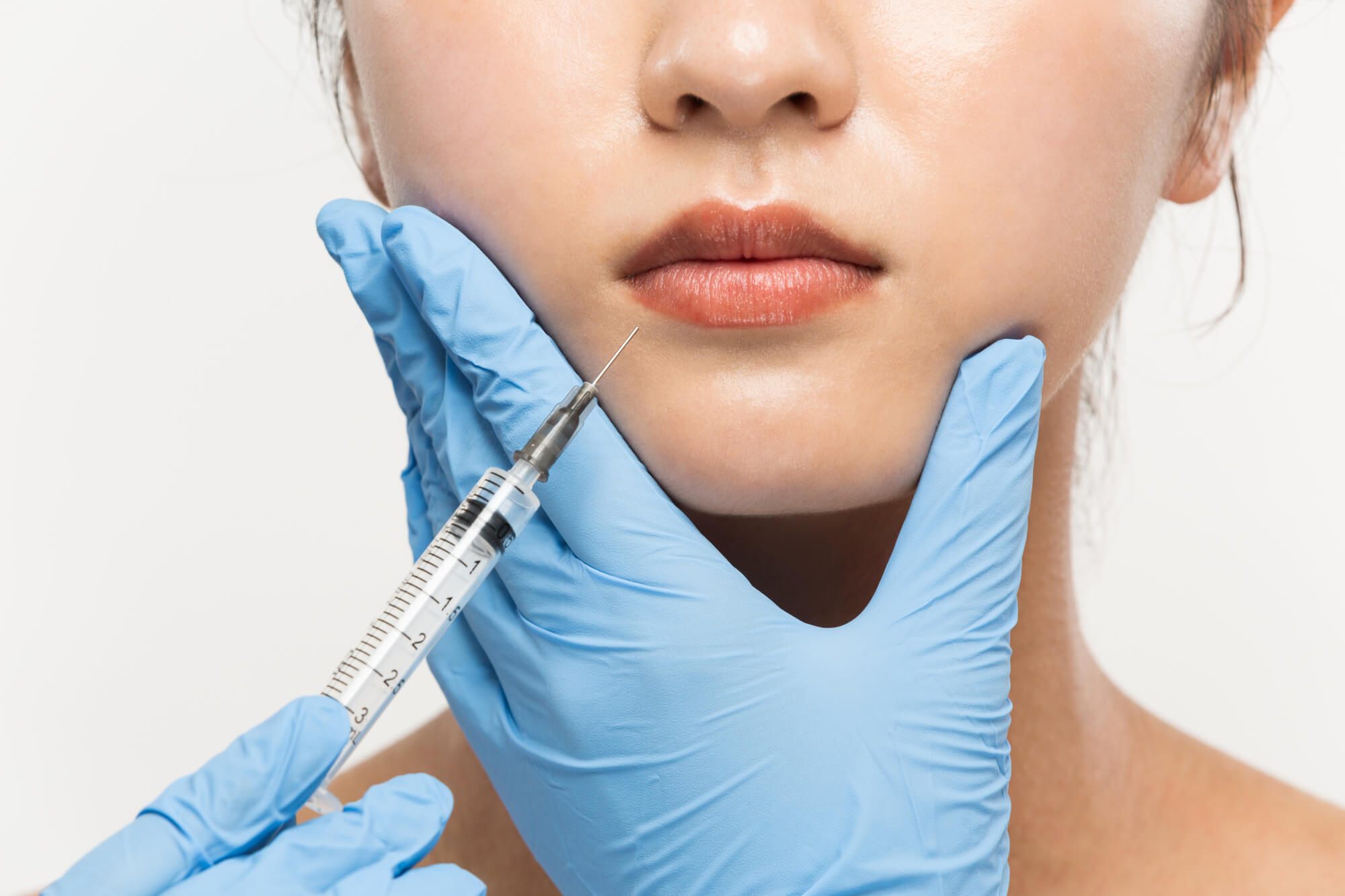 マリオネットラインの整形で得られる効果
