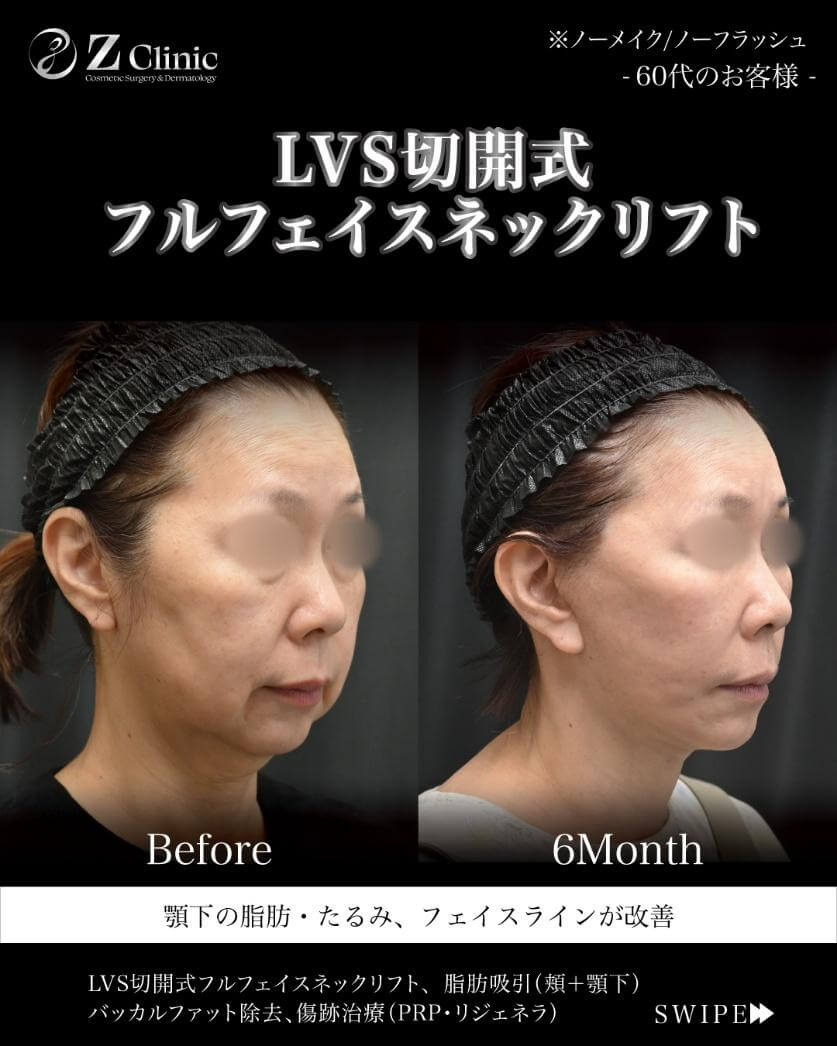 LVS切開式フルフェイスネックリフトを受けられた60代女性の症例写真