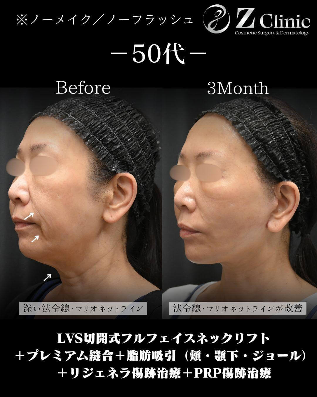 顎下・頬・ジョールファットの脂肪吸引をおこなった50代女性の症例写真。