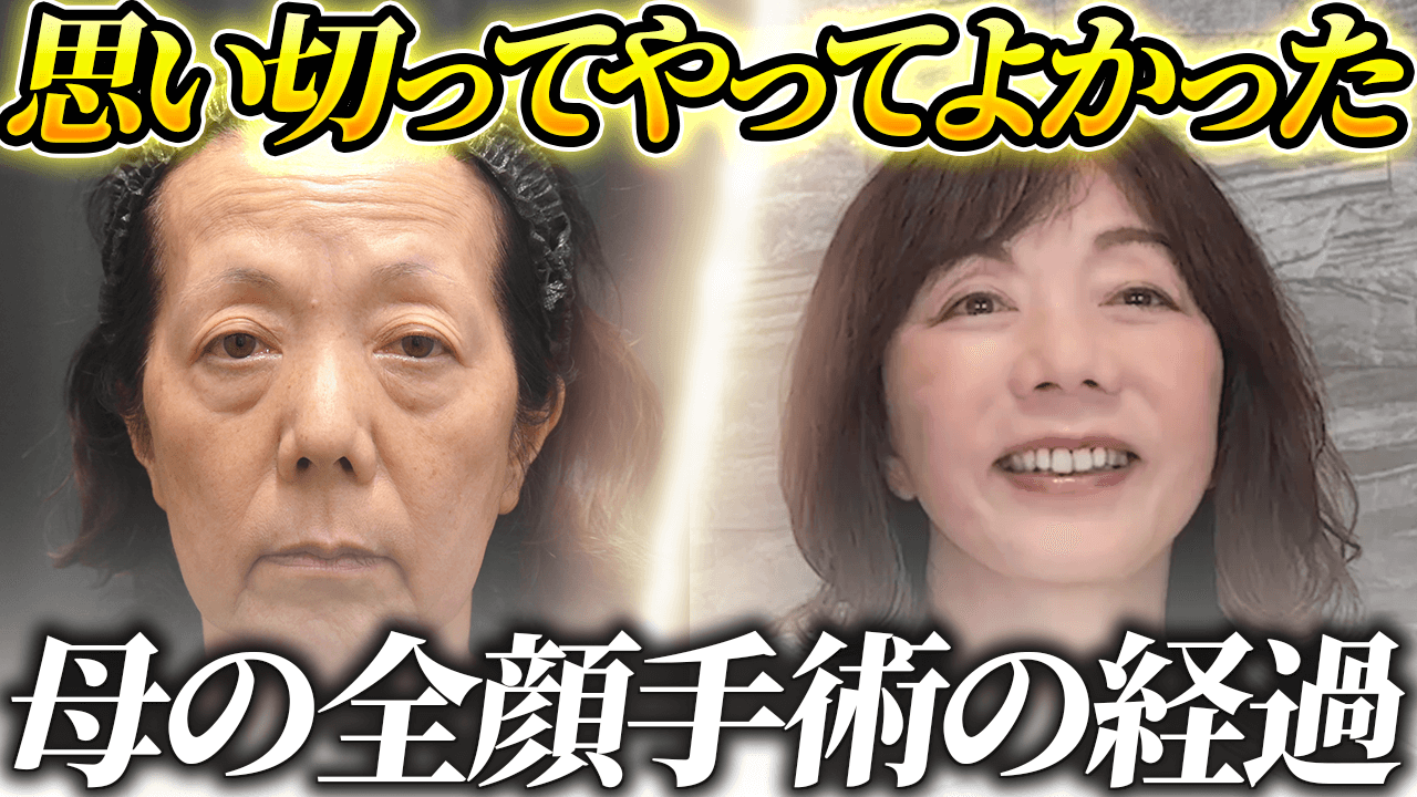東京・銀座で眉下切開・眉下リフトの美容クリニックzclinicの画像4