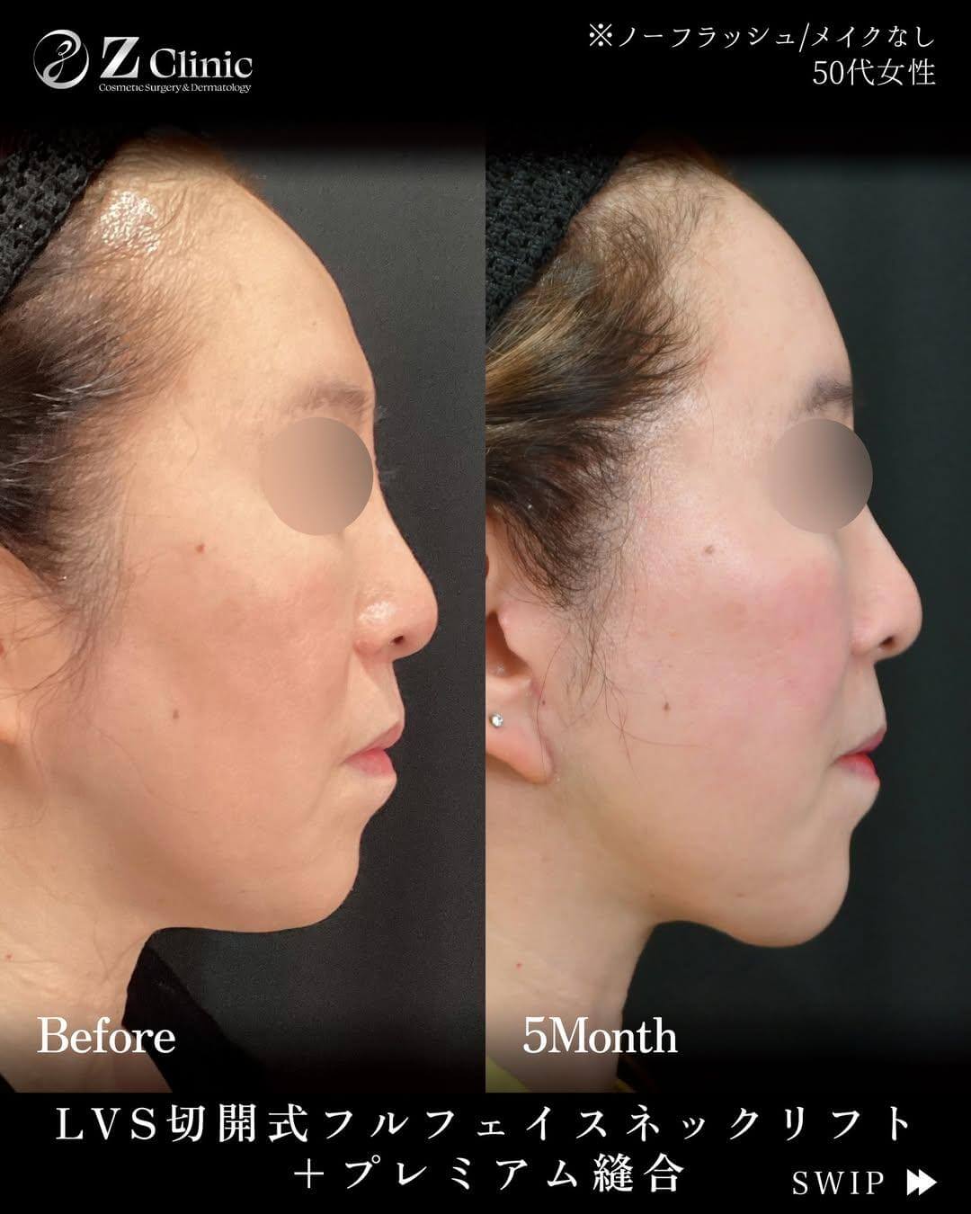 顎先への脂肪注入をおこなった50代女性の症例写真