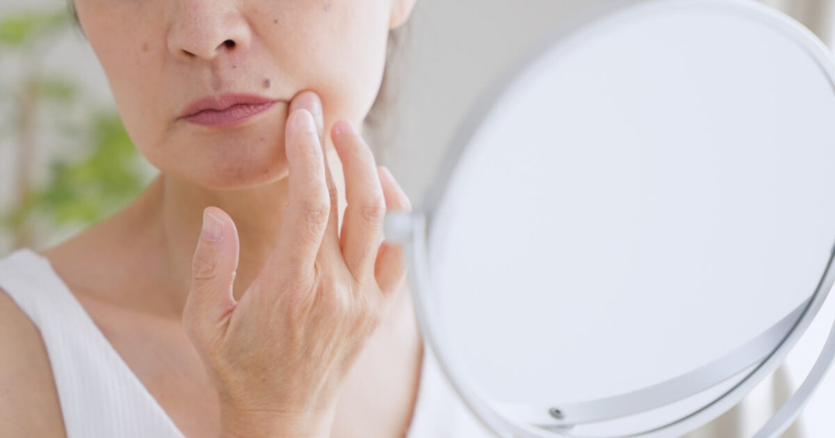 マリオネットライン脂肪注入|施術内容や注意点など徹底解説