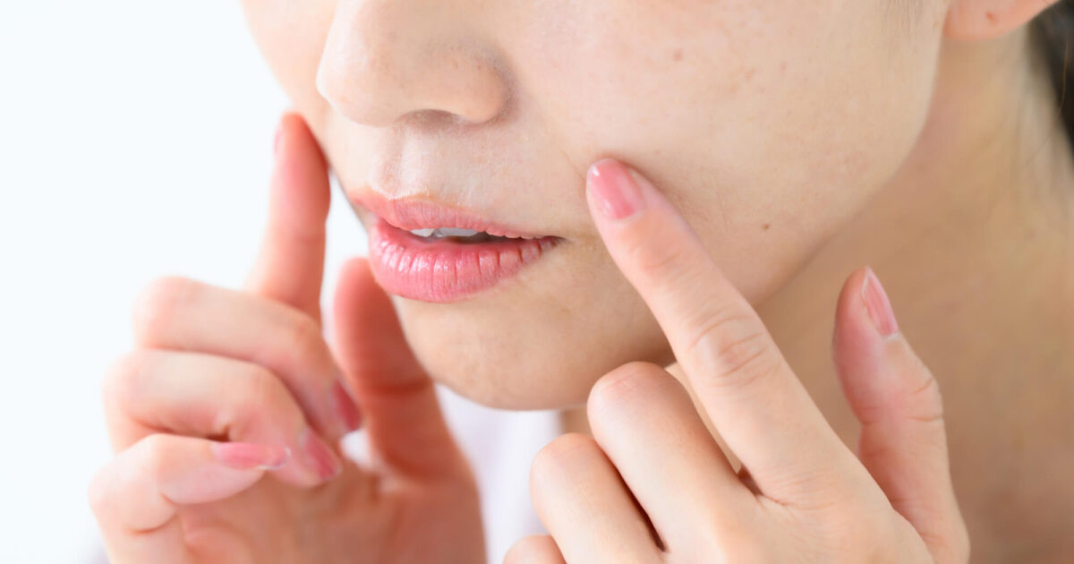糸リフトのダウンタイムはどれくらい？期間や経過ごとの症状と過ごし方を解説